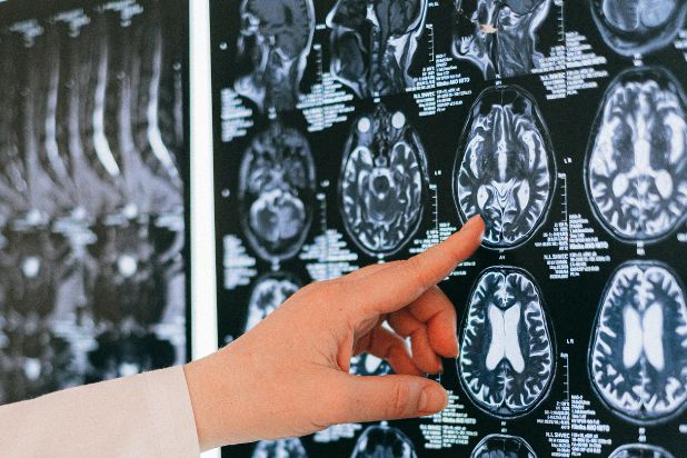 Medyk, lekarz palcem wskazuje element zdjęcia TK mózgu